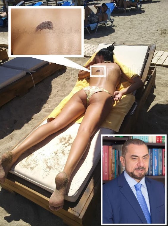 Η Εβδομάδα Μελανώματος και κατά του Καρκίνου του Δέρματος έχει ως κύριο στόχο να αφυπνιστούν όλοι για τις βλαβερές συνέπειες της ηλιακήςακτινοβολίας και να ενημερωθούν για τη σημασία της έγκαιρης διάγνωσης του μελανώματος. Σχετικά με το πρόβλημα αυτό, ο πλαστικός χειρουργός κ. Αθανάσιος Χριστόπουλος αναφέρει: «Η έγκαιρη διάγνωση του καρκίνου του δέρματος είναι σημαντική και τις περισσότερες φορές σωτήρια για την υγεία και ζωή του ασθενούς»