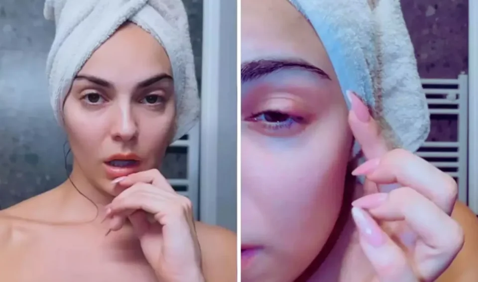 Βρισηίδα Ανδριώτου: Με πρησμένο μάτι στο Instagram
