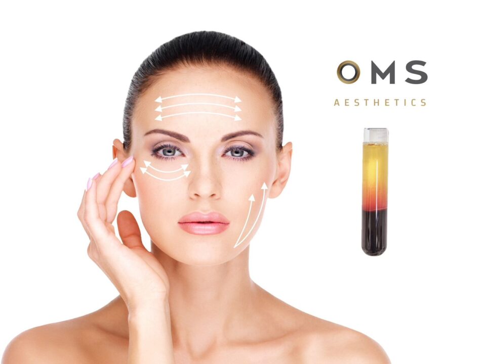 Η O.M.S. Aesthetics μας προτείνει την θεραπεία με P.R.P. . Μια σύγχρονη θεραπεία αναγέννησης στην υπηρεσία της Ιατρικής!